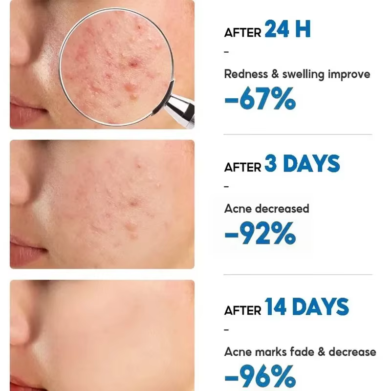 Crème anti-acné à l'acide salicylique