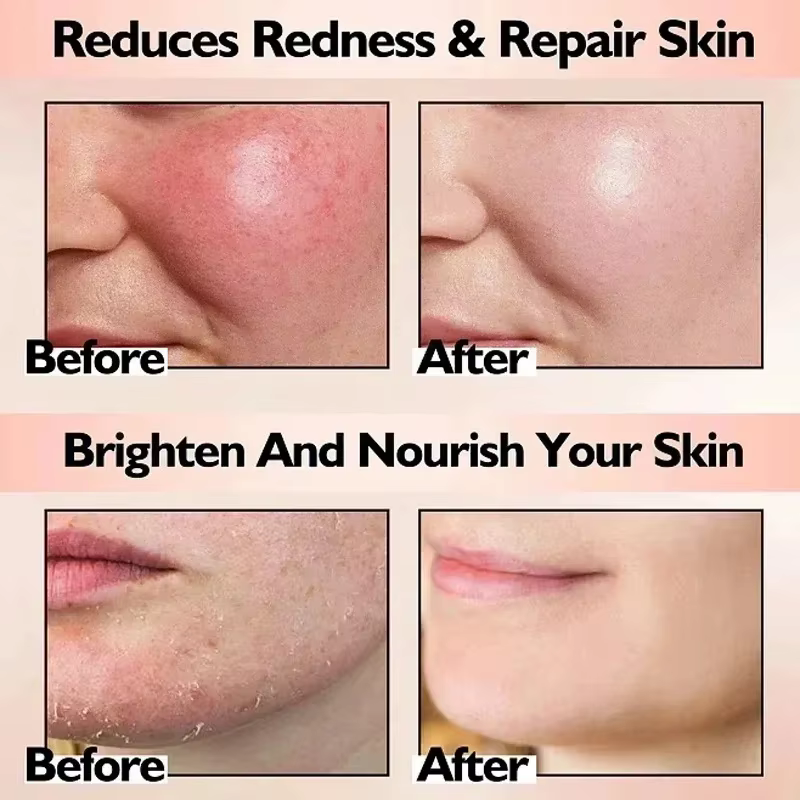 Crème réparatrice pour les rougeurs du visage