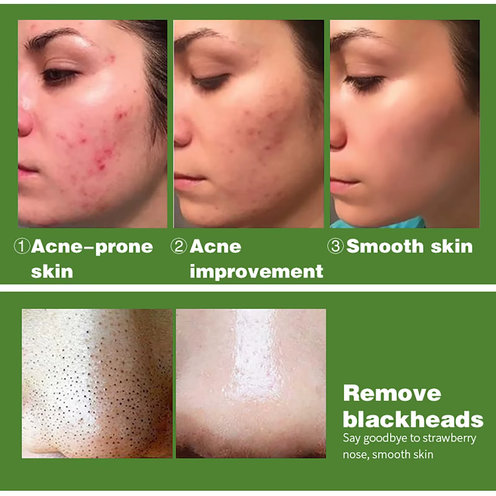 Ensemble de soins du visage anti-acné biologique AILKE