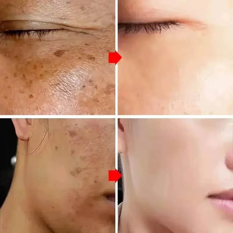Crème blanchissante puissante anti-taches