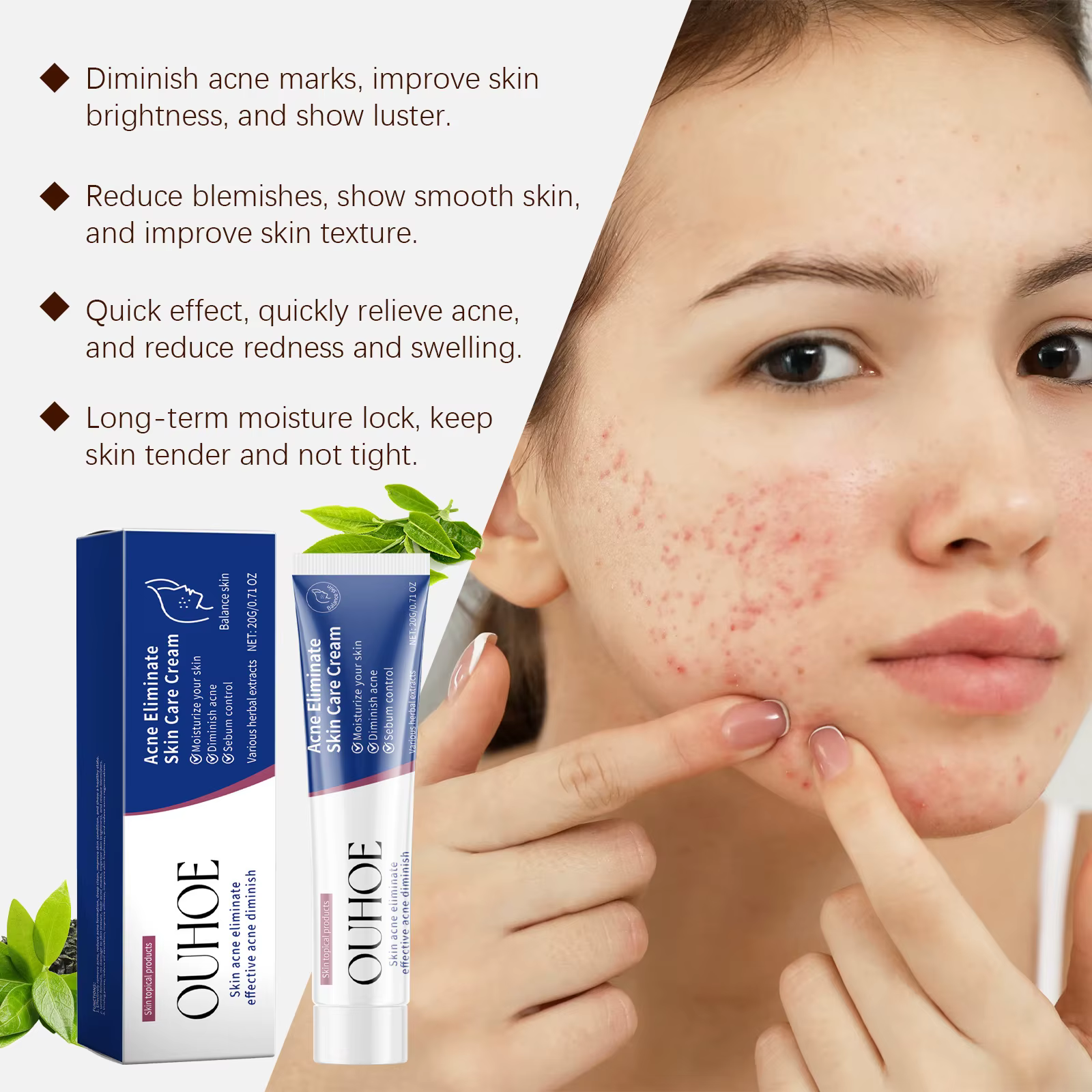 Crème de traitement de l'acné pour le visage
