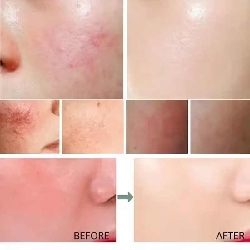 Crème réparatrice pour les rougeurs du visage