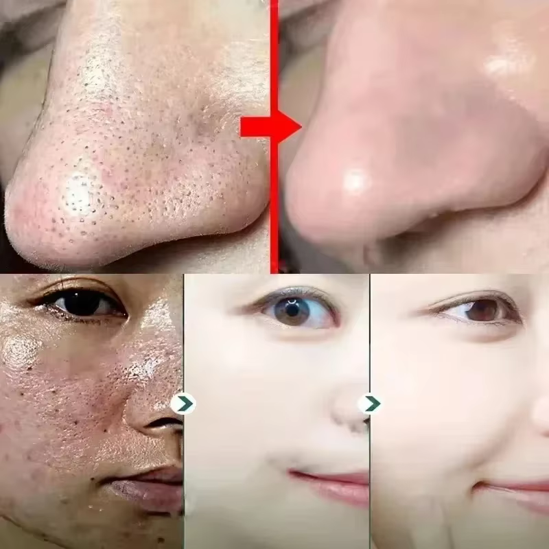 Masque rétrécissement des pores à l'acide salicylique