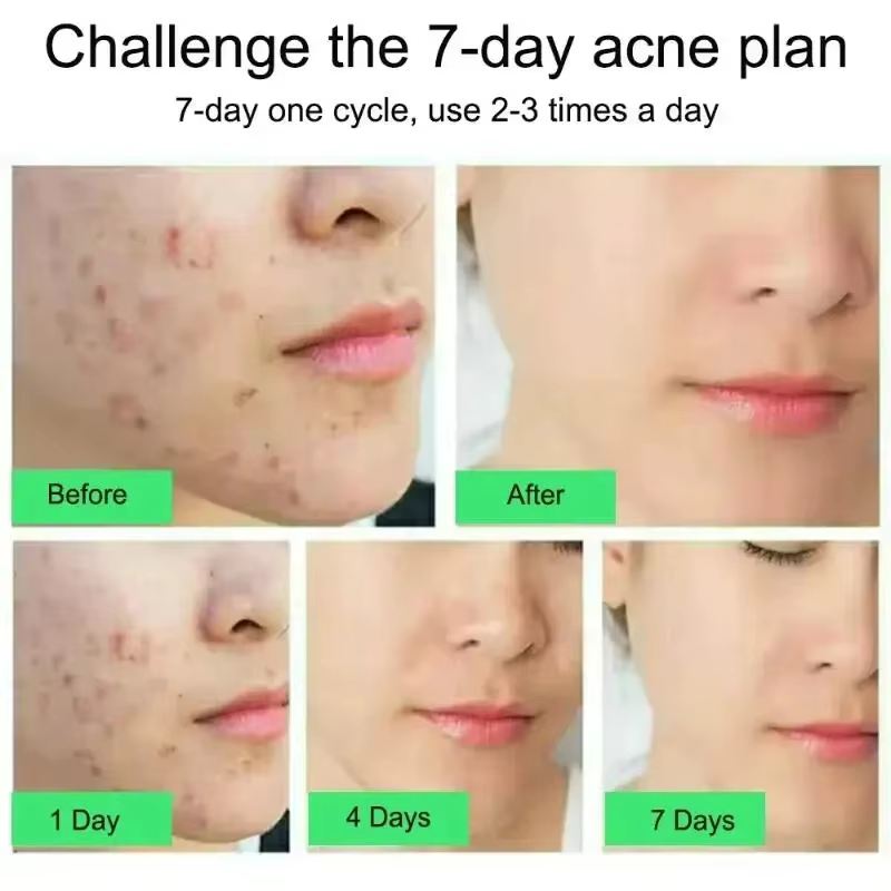 Crème anti-acné à l'acide salicylique
