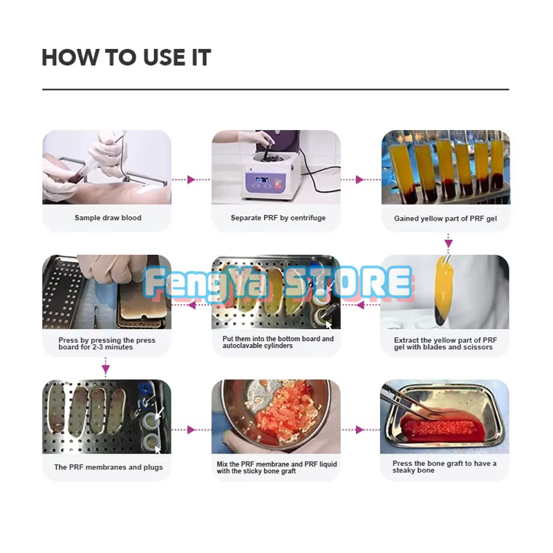 1 Ensemble de Boîtes PRF GRF Dentaires en Acier Inoxydable pour Plaques d'Implants, Boîte de Fibrine Riche, Boîte PRF Odontologie, Boîte PRF pour Implants Dentaires