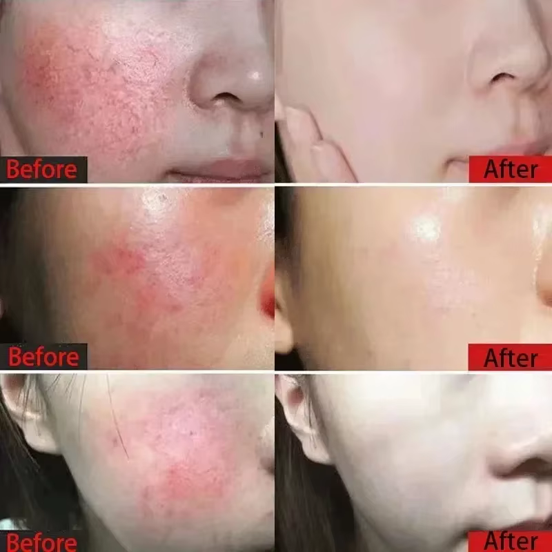 Crème réparatrice pour les rougeurs du visage