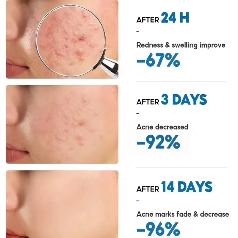 Crème Visage Anti-Acné à Base de Plantes