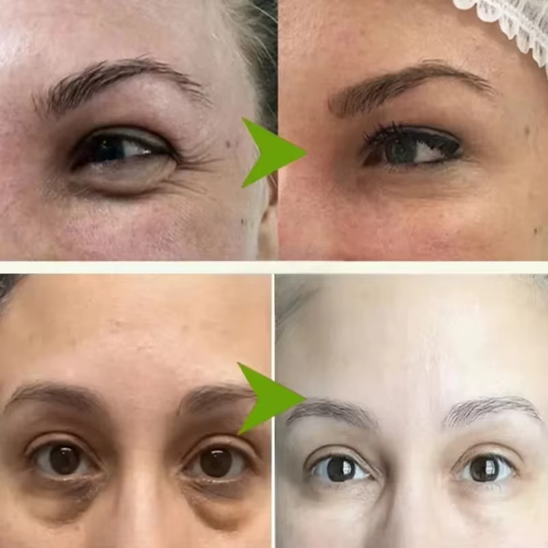 Dissolvant de granulés de graisse crème pour les yeux efficace élimine