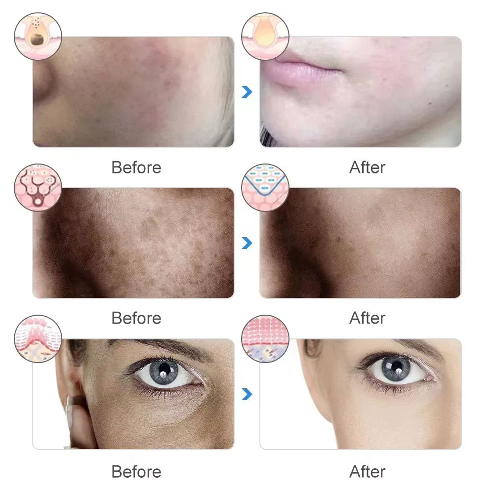 Masque facial LED, thérapie à la lumière
