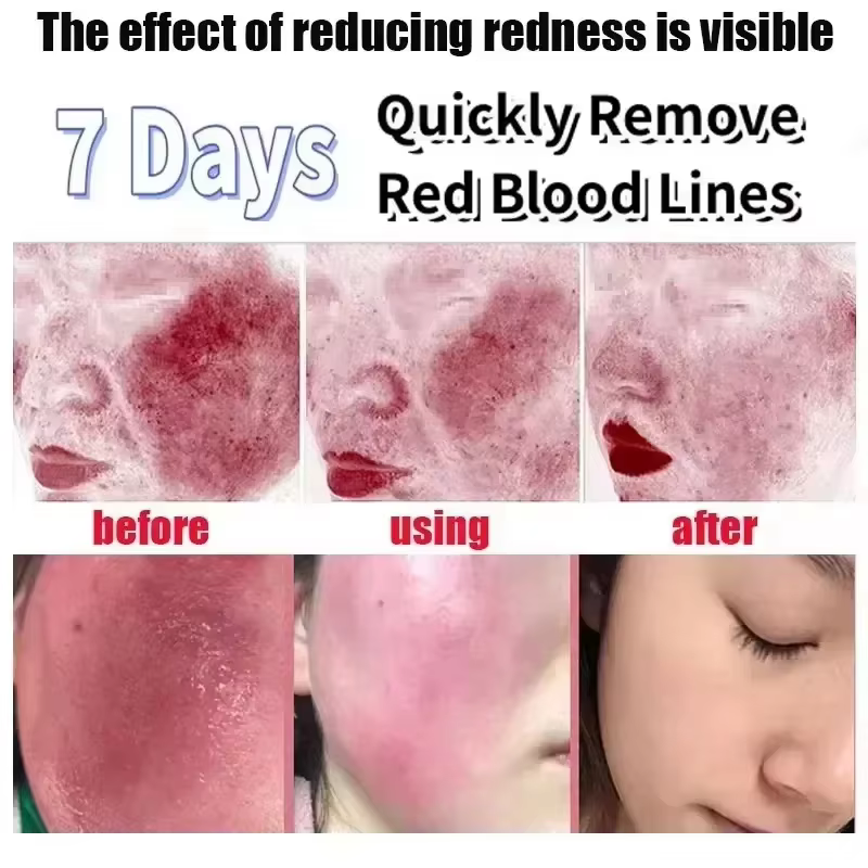 Crème Réparatrice Anti-Rougeurs Visage – Améliore la Peau Sensible et la Sécheresse – Lotion Hydratante Apaisante – Élimine la Rosacée – Jour et Nuit – Cosmétiques Coréens